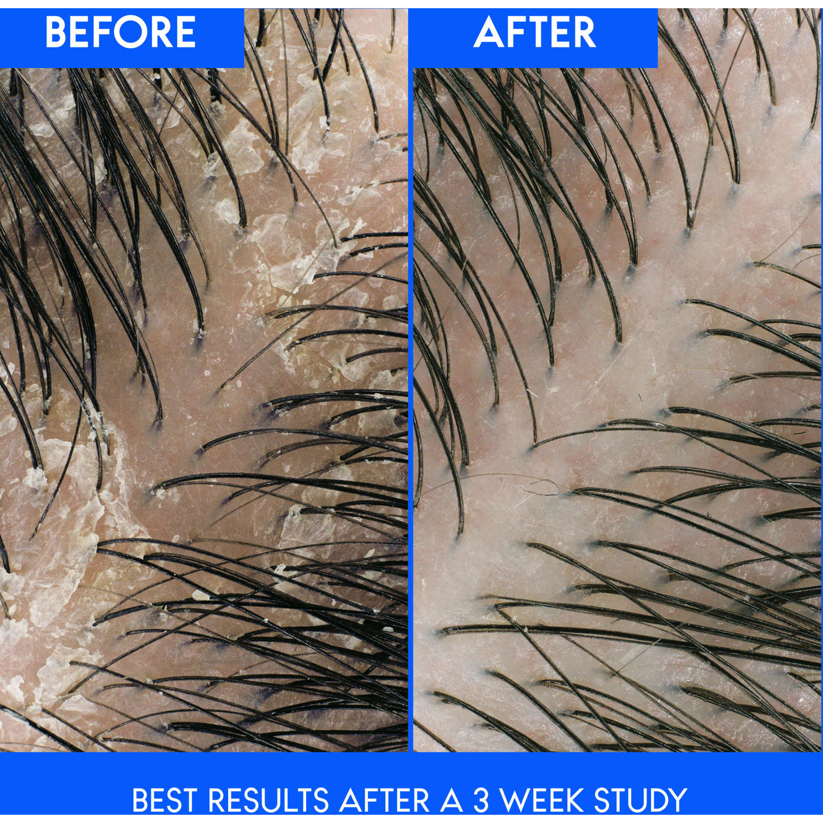 Dry Scalp Anti-Dandruff Shampoo